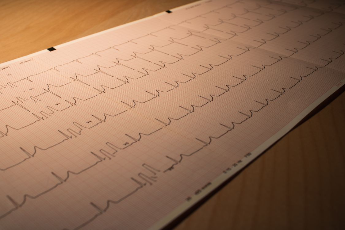 Tracé d'électrocardiogramme sur papier montrant le rythme cardiaque